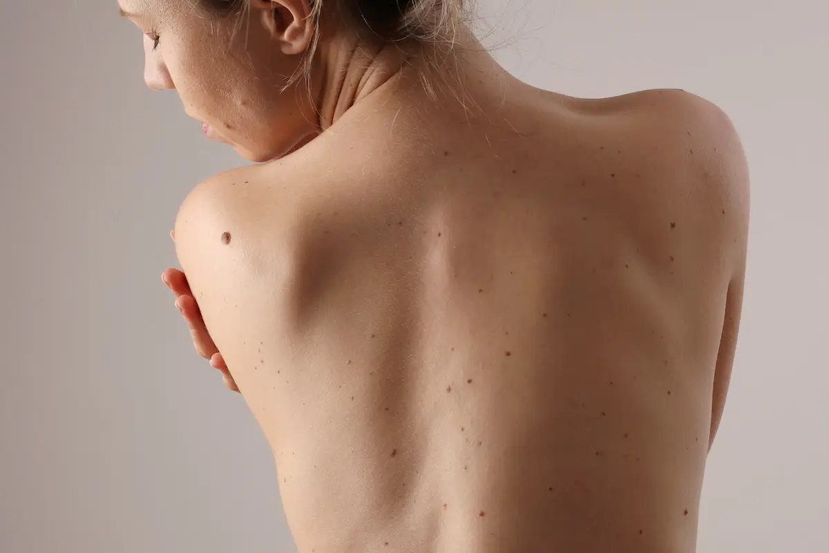 Rücken auf dem eine Person einen Muttermal und Leberfleck entfernen möchte