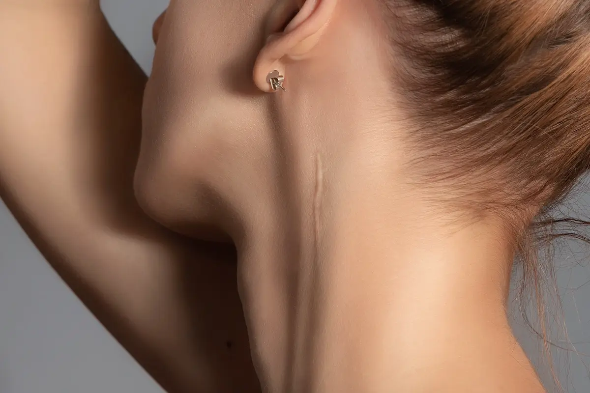 Eine lange Narbe am Hals, die eine Frau entfernen möchte