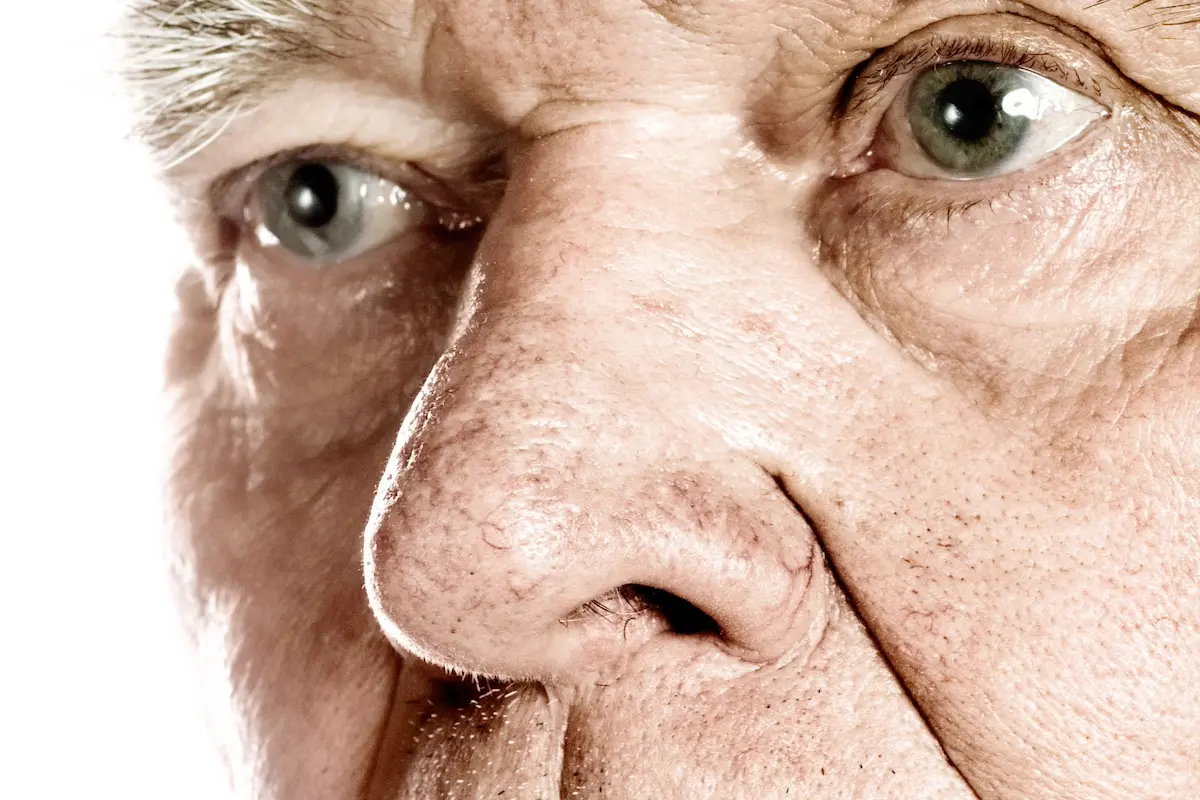 Ein Mann der seinen Rhinophym in München entfernen möchte